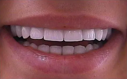 How to judge whether the porcelain teeth made in Shenzhen are good or not?