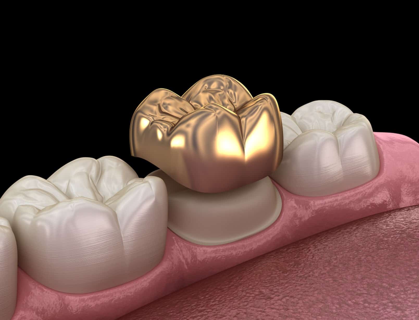 Macau dental crown price: What are the differences between the three types of dental crowns