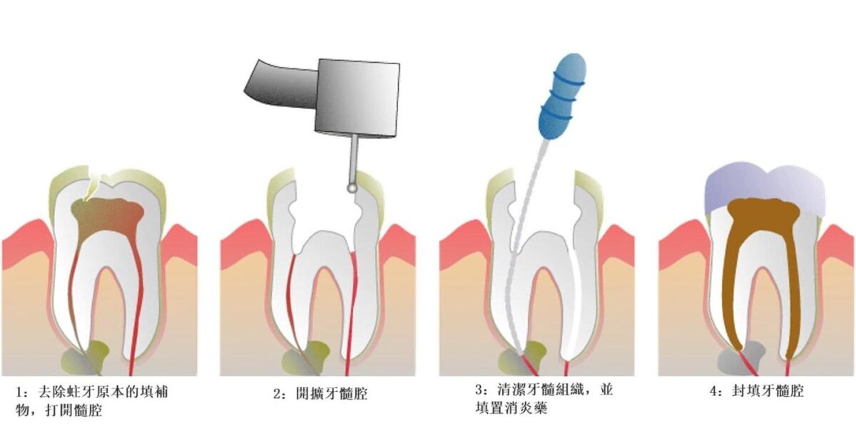 Price of root canal treatment in Macau