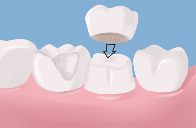 Macau dental crown price