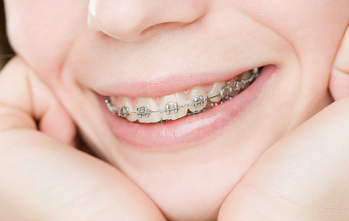 Macau Orthodontic Price 2024