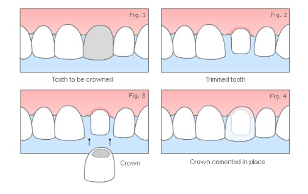 Macau denture braces price