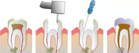 Macau Root Canal treatment price and money-saving package