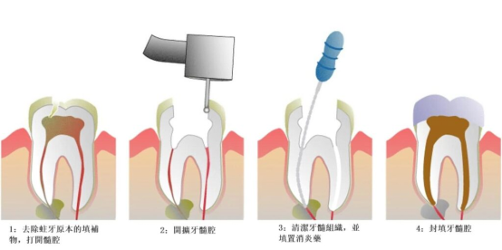 Macau root canal treatment price, where is the doctor charge the flat gesture is good?