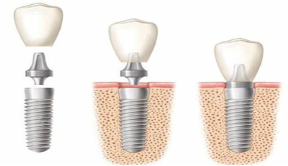 The process and cost of dental implants in Macau