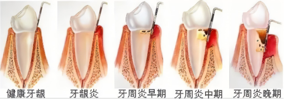 Macau Dental Clinic - Periodontal Treatment Guide