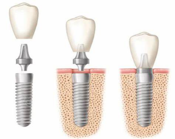 Macau dental implants, the need for care can be used longer?