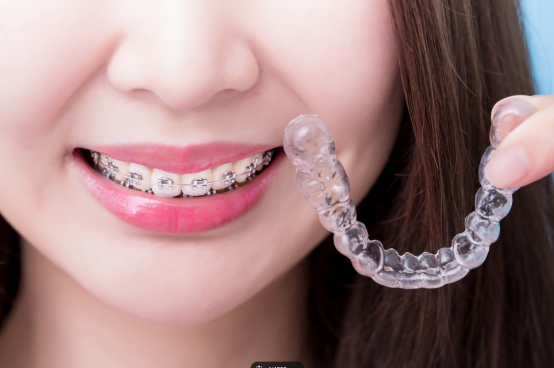 A guide to the prices and procedures of orthodontics in mainland ChinaIn