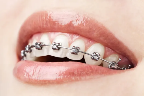 Macau Orthodontics: A New Option for Modern Orthodontics