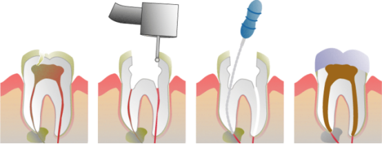 The process of the root of the tooth in Macau is the same as the precautions