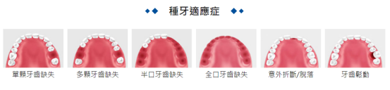 Dental implants in Macau are transparent and free of charge | Recommended by Macau dentists, guaranteed by strength