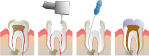 Macau Root Canal Therapy Prices and Burial FAQs