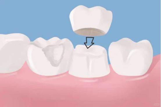 Macau Dental Crown Price