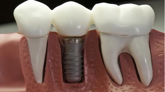 Comparison of the cost of dental implants in Zhuhai and Macau