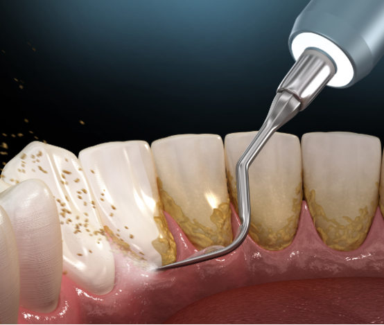 Where to Get Teeth Cleaning in Macau? The Importance of Periodontal Disease and Oral Health